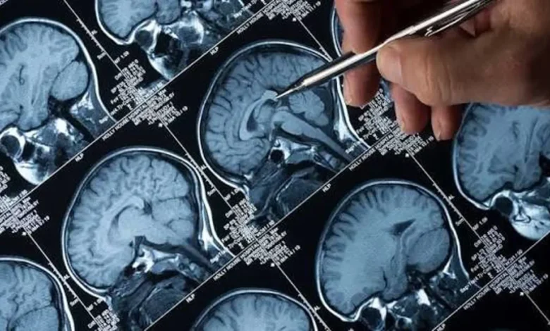 العلاج بالرنين المغناطيسي المتكرر... حل فعّال لمواجهة الاكتئاب