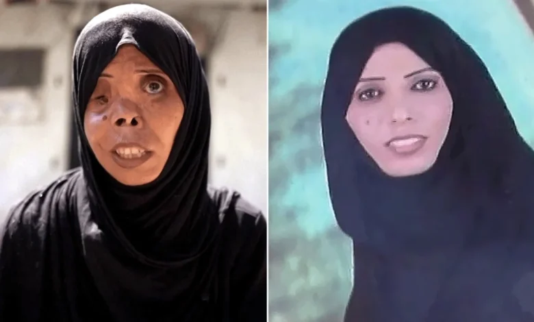 لا مأوى ولا عمل وتشوهات جسدية.. هكذا حولت الحرب الإسرائيلية الحياة في غزة